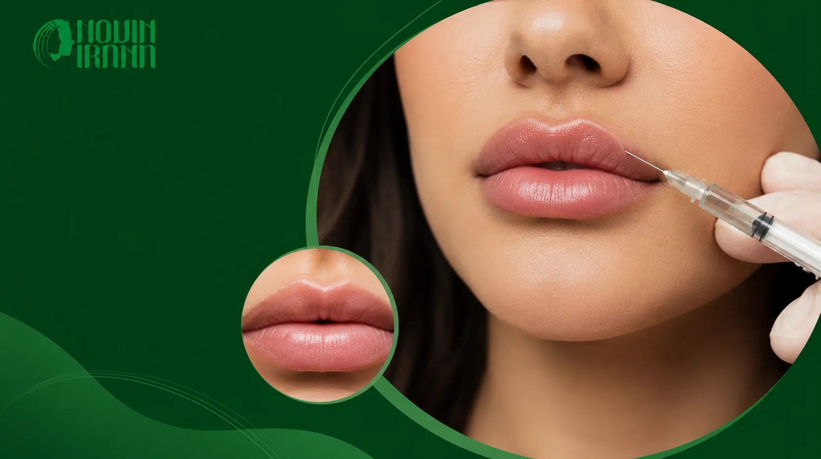 ژل لب مدل چاک دار مشهد چیست؟